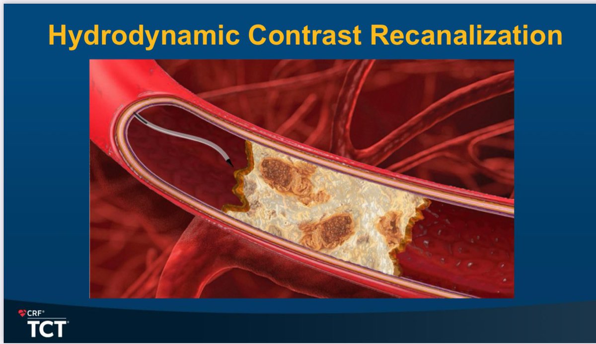 Interesting novel technique for CTO crossing presented by Salman Arain. #TCT2024 <a href="/crfheart/">Cardiovascular Research Foundation</a> <a href="/TCTMD/">TCTMD</a>