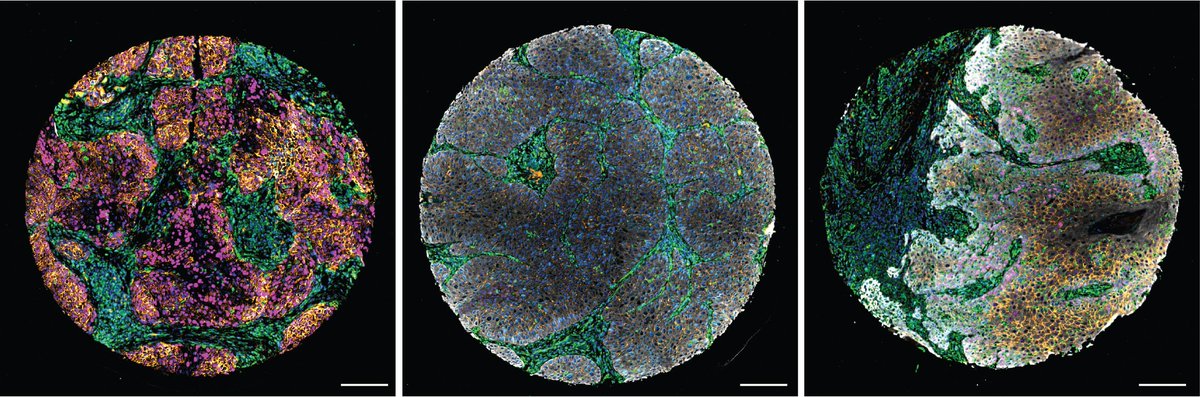 MPI Molecular Biomedicine (@mpi_muenster) on Twitter photo New imaging analysis method revolutionizes diagnosis of head and neck tumors – amazing study by Sara Wickström's team combines morph. and cell status markers at single-cell resolution. @Wickstromlab <a href="/MPI_Muenster/">MPI Molecular Biomedicine</a> <a href="/helsinkiuni/">University of Helsinki</a> <a href="/UniTurku/">Turun yliopisto - University of Turku</a> <a href="/HiLIFE_helsinki/">HiLIFE_Helsinki</a> s.academiccloud.de/1CIGB6 New imaging analysis method revolutionizes diagnosis of head and neck tumors – amazing study by Sara Wickström's team combines morph. and cell status markers at single-cell resolution. @Wickstromlab <a href="/MPI_Muenster/">MPI Molecular Biomedicine</a> <a href="/helsinkiuni/">University of Helsinki</a> <a href="/UniTurku/">Turun yliopisto - University of Turku</a> <a href="/HiLIFE_helsinki/">HiLIFE_Helsinki</a> s.academiccloud.de/1CIGB6