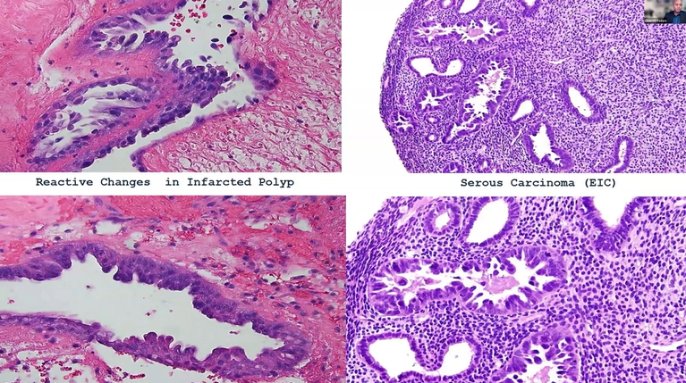 Janiranavarro's tweet photo. Uterus-Endometrial polyps
Reactive changes in infarcted polyp (left)
Serous carcinoma (right)

Dr. Fadare #isgyp #Gynpath #PathTwitter #pathX #pathologists #pathresidents #pathfellow #NIPPathX