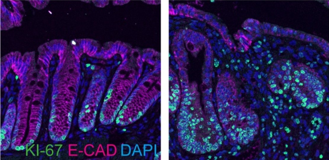 Charité - Universitätsmedizin Berlin (@chariteberlin) on Twitter photo Menschen mit Colitis ulcerosa haben ein höheres Darmkrebsrisiko. Die Rolle des Gens p53 dabei und wie man Krebsvorläufer möglicherweise früh medikamentös ausschalten könnte, beschreiben Forschende der #CharitéBerlin und des <a href="/MDC_Berlin/">Max Delbrück Center</a> in <a href="/ScienceAdvances/">Science Advances</a>. charite.de/forschung/pape… Menschen mit Colitis ulcerosa haben ein höheres Darmkrebsrisiko. Die Rolle des Gens p53 dabei und wie man Krebsvorläufer möglicherweise früh medikamentös ausschalten könnte, beschreiben Forschende der #CharitéBerlin und des <a href="/MDC_Berlin/">Max Delbrück Center</a> in <a href="/ScienceAdvances/">Science Advances</a>. charite.de/forschung/pape…