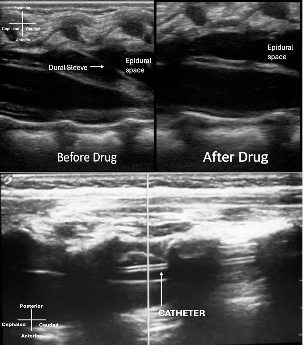sub_vv's tweet photo. Real-Time Ultrasonography for the Placement of Caudal Epidurals for Thoracic Surgery in Infants.

https://t.co/TGQkTzBctV

Placing caudal catheters at specific intervertebral spaces and mimicking and dosing them as thoracic epidurals! Safer and lower doses! https://t.co/aaS1cgu2FW