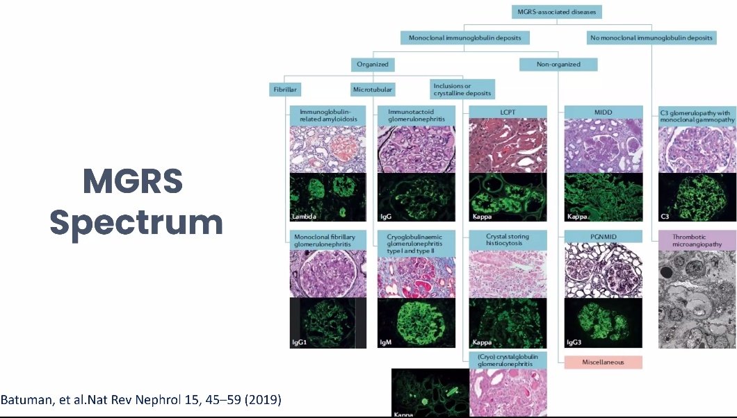 Kajaree Giri (@kajareeg) on Twitter photo 🫘The renal spectrum of MGRS
✅Renal and metabolic complications of paraproteinemias!
🎯Talk by <a href="/happiedoc/">Subashri</a>
In <a href="/WomenNeph_india/">Women in Nephrology-India</a> webinar <a href="/SwarnalathaGud2/">Swarnalatha Guditi</a> <a href="/AnandhUrmila/">Urmila Anandh</a> <a href="/priti899/">Dr Priti MD,FASN🇮🇳 (प्रिति)</a> <a href="/nephronisha/">Isha Tiwari</a> <a href="/krithicism/">Krithika Mohan</a> 🫘The renal spectrum of MGRS
✅Renal and metabolic complications of paraproteinemias!
🎯Talk by <a href="/happiedoc/">Subashri</a>
In <a href="/WomenNeph_india/">Women in Nephrology-India</a> webinar <a href="/SwarnalathaGud2/">Swarnalatha Guditi</a> <a href="/AnandhUrmila/">Urmila Anandh</a> <a href="/priti899/">Dr Priti MD,FASN🇮🇳 (प्रिति)</a> <a href="/nephronisha/">Isha Tiwari</a> <a href="/krithicism/">Krithika Mohan</a>