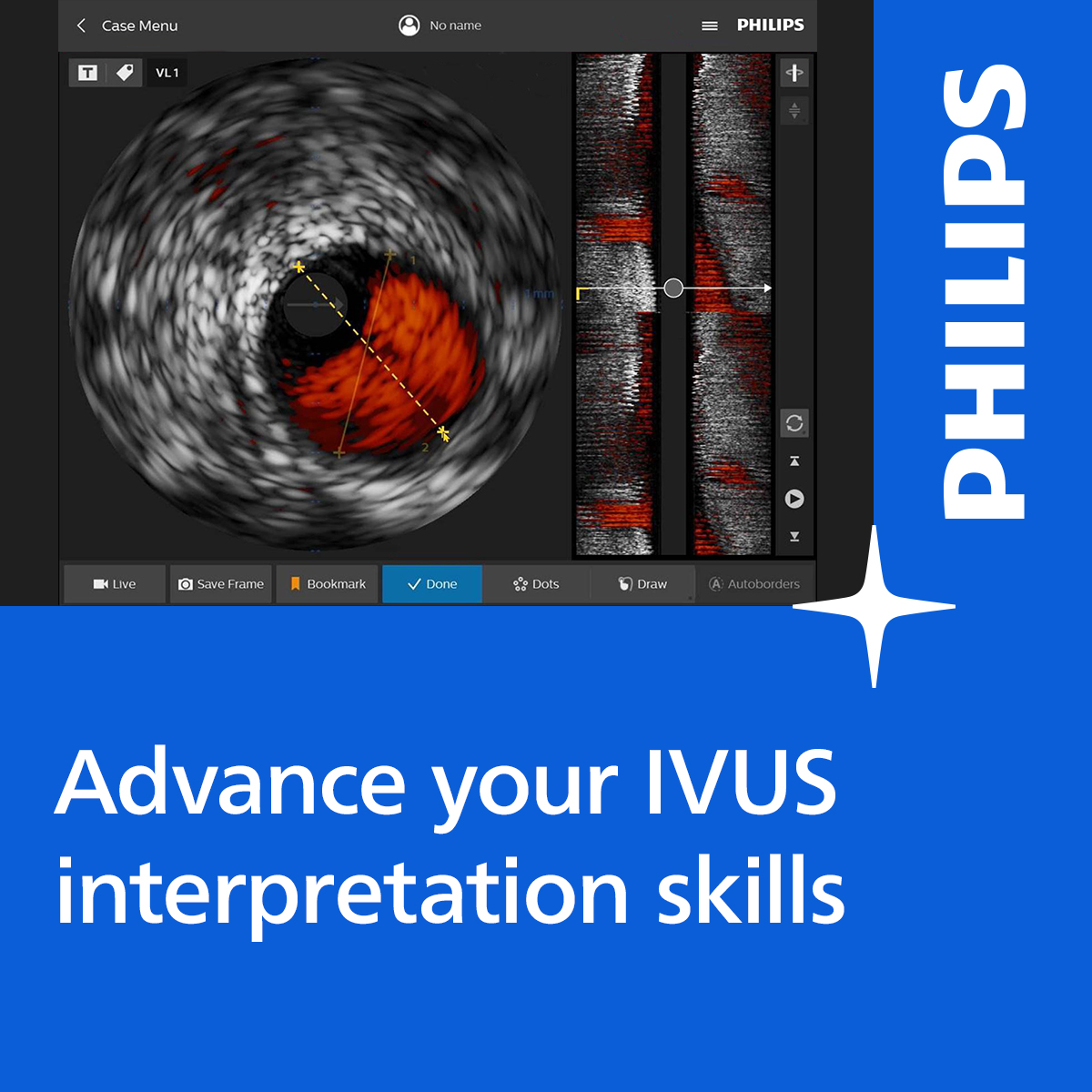 Philips Interventional Cardiology tweet media