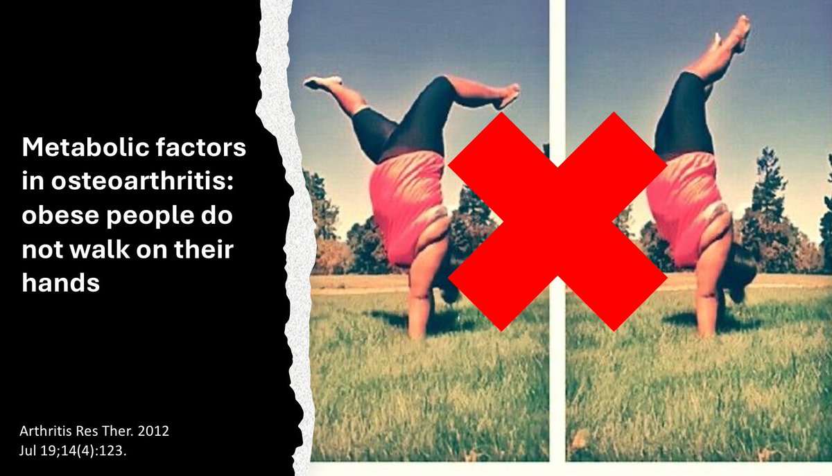 The links between OA and obesity is not due to excess loading of the articular surfaces causing “wear and tear” it is a metabolic issue causing low grade inflammation and tissue sensitisation.  OA of the hand is more prevalent in obese OA patients, the risk is doubled.