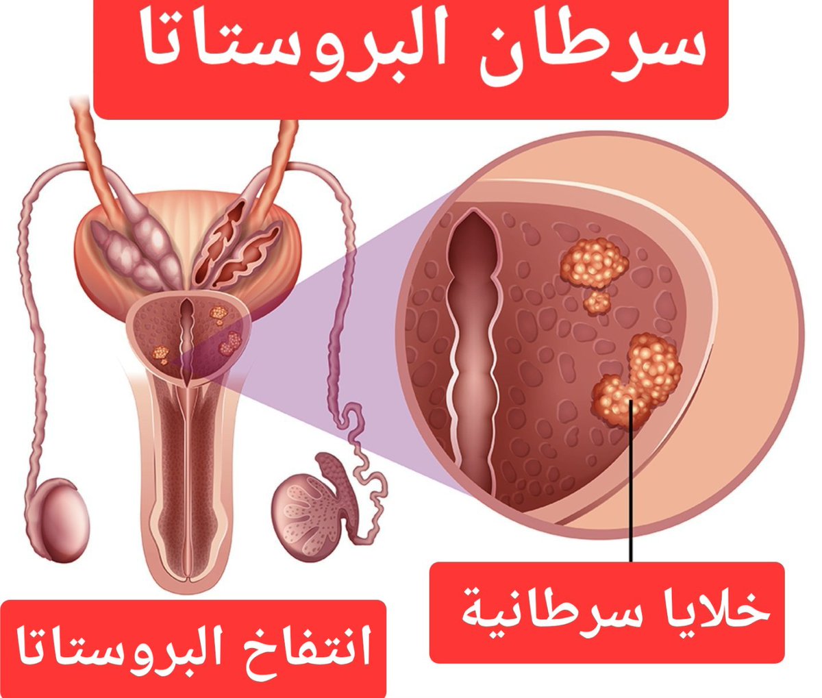 arabaltmed's tweet photo. 1️⃣
يعاني العديد من الشباب بالفعل من اعراض أوليه للبروستاتا ولكنهم للاسف لا يعرفون ذلك.
سيتم ذكر بعضها في هذا الثريد لان من يراجعني لمشاكل البروستاتا شباب في أواخر العشرينات من العمر.
البروستاتا في حال لم تعرفها من قبل 
تقع البروستاتا تحت المثانة البولية تمامًا وقبالة المستقيم، https://t.co/D13k8HKVlz
