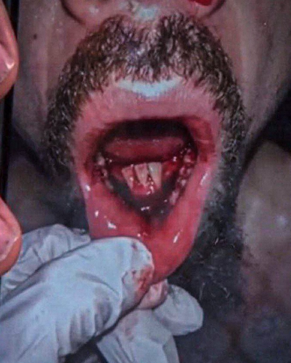 ⚠️ IMAGES SENSIBLES ⚠️

La mâchoire de Robert Whittaker après son combat face à Khamzat Chimaev ! 🩸

On comprend mieux maintenant… 😨

#UFC308