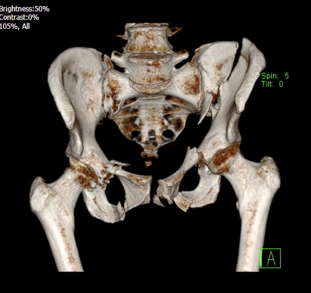 The Oxford Trauma Service, invite applicants for the prestigious *Post-CCT* Trueta Orthopaedic Trauma Fellowship program. 

We have positions available in Feb and Aug 26 

No nights, no weekends but A LOT of operating!

beta.jobs.nhs.uk/candidate/joba…