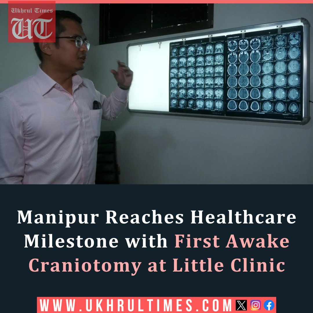 ukhrultimes's tweet photo. #Imphal: In a groundbreaking achievement for #Manipur’s #healthcare sector, doctors at Little Clinic have successfully performed the state’s first-ever #AwakeCraniotomy, removing a #braintumor from a 58-year-old patient without anesthesia. Read more | https://t.co/EZAMAqHUCg https://t.co/FZBrsDjM0m