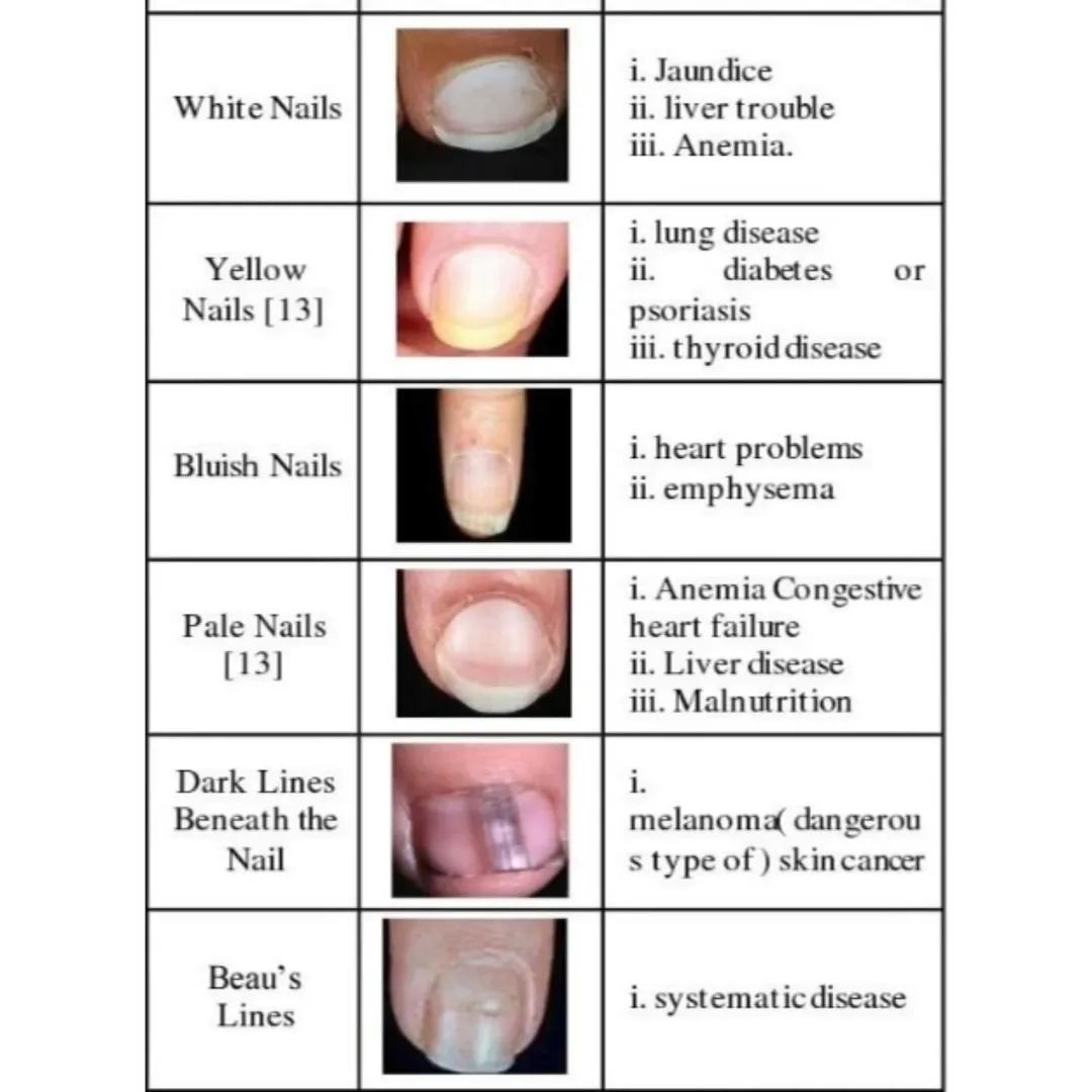 famiabd2012's tweet photo. Ditect diseases with color of nails. https://t.co/uBcdAUiTZH