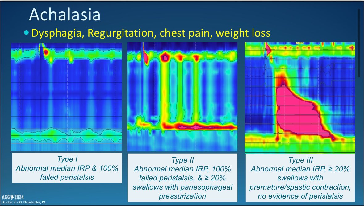 CarlKayMD's tweet photo. Three Types of Achalasia
1️⃣ Type 1: “Peristalsis is nONE”
2️⃣ Type 2: “Two (too) tight!”
3️⃣ Type 3: “Three-Peatedly Spasms”
Definitely going to see this on November 20th for @ABIMcert! #boardfodder
#ACG2024 https://t.co/o4KJR5t89o