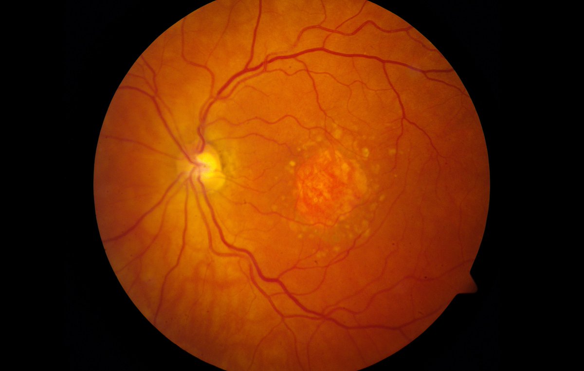 #AAO2024: In eyes with #GeographicAtrophy (GA), the amount of sharp vision a patient loses may depend on closeness of the lesion to #FovealCenter, level of baseline #BestCorrectedVisualAcuity (BCVA), and pace of GA growth. <a href="/aao_ophth/">AAO</a> 

Presented by <a href="/LinusShenMD/">Linus Shen, MD</a>. 

Read more:
