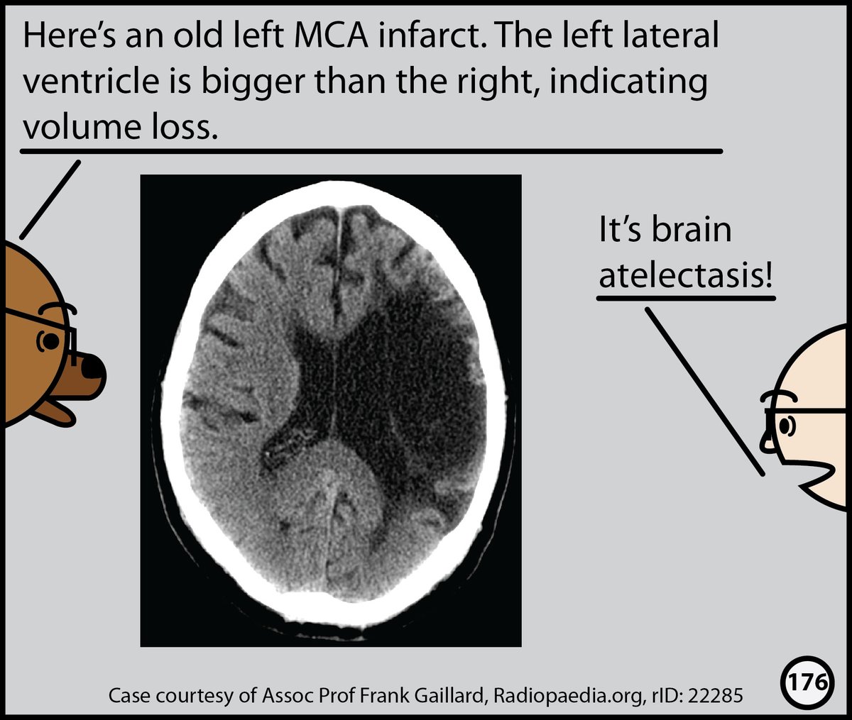 Stefan Tigges (@stefantigges) on Twitter photo This month, I’ll post excerpts from our Head CT comic. The complete comic is available for free here: radiopaedia.org/courses/head-c… This month, I’ll post excerpts from our Head CT comic. The complete comic is available for free here: radiopaedia.org/courses/head-c…