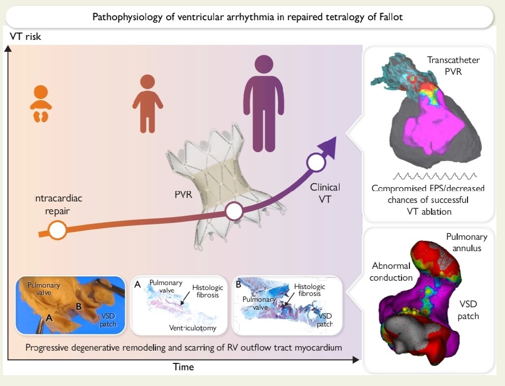 ESC WG on ACHD Chairperson (@wgachdchair) on Twitter photo The evolving ventricular arrhythmia substrate in Tetralogy of Fallot ✅
#ACHD #CHD <a href="/GiancarloS1111/">Giancarlo Scognamiglio</a>
<a href="/MoonsPhilip/">Philip Moons</a> <a href="/raqpri1977/">Raquel Prieto</a>
<a href="/JavierRuperti/">Javier Ruperti</a> <a href="/JSabatino86/">Jole Sabatino</a>
📖 Read more:
doi.org/10.1093/eurhea…
Congratulations JP Moore, <a href="/KhairyPaul/">Paul Khairy</a> et al The evolving ventricular arrhythmia substrate in Tetralogy of Fallot ✅
#ACHD #CHD <a href="/GiancarloS1111/">Giancarlo Scognamiglio</a>
<a href="/MoonsPhilip/">Philip Moons</a> <a href="/raqpri1977/">Raquel Prieto</a>
<a href="/JavierRuperti/">Javier Ruperti</a> <a href="/JSabatino86/">Jole Sabatino</a>
📖 Read more:
doi.org/10.1093/eurhea…
Congratulations JP Moore, <a href="/KhairyPaul/">Paul Khairy</a> et al