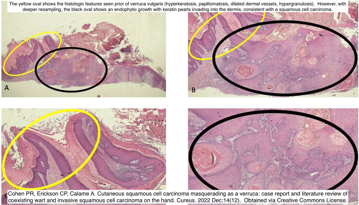 Path4People's tweet photo. #pathtip

🔪 Sampling of a wart (eg. verruca vulgaris) can be difficult esp if superficial and base cannot be visualized

⚠️ Squamous cell carcinoma (SCC) can have warty surface appearance

⬇️ A case of wart that ➡️ in fact, SCC

#pathx #dermpath #fammed #path4people #pathagonia https://t.co/ivPhYFWfeT