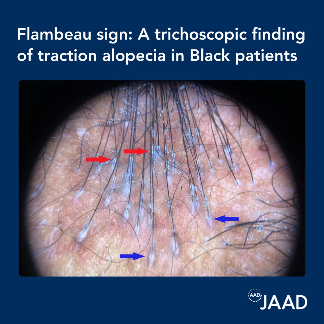 Resembling a torch, the flambeau sign is a trichoscopic finding indicative of fibrosis in traction alopecia (TA). The affected area of traction shows linear white tracks in the direction of hair pull.  bit.ly/4hfbWd4