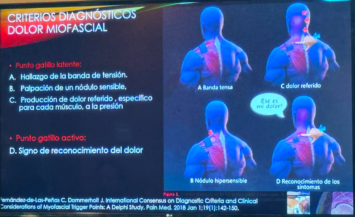 📍 Intervencionismo #dolor miofascial
🎓 <a href="/MJordaLlona/">Mónica Jordá Llona</a> <a href="/GVADrPeset/">DS Doctor Peset</a>

 ▶️ PUNCIÓN SECA y otras técnicas
🎙️ Dr. JMClimentB
🏥 #HGUAlicante <a href="/GVAsalualicante/">GVADptoSaludAlicante</a>

📍 IV Congreso <a href="/SEMDOR2/">SEMDOR Soc. Esp. Multidisciplinar del DOLOR</a>
👉🏼 congresosemdor.es

🧵 4/4 #congresoSEMDOR2024