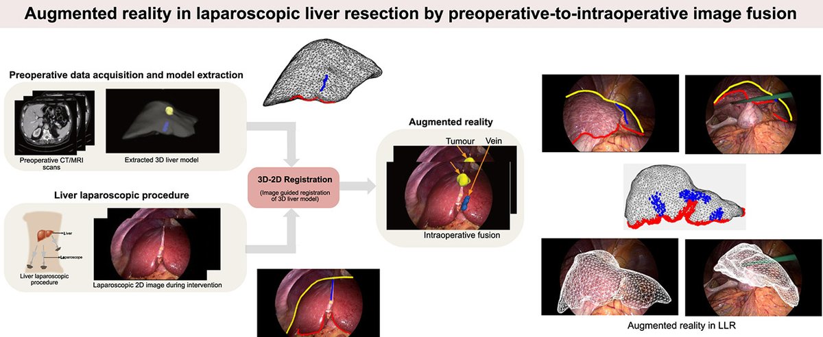 vision_sharib's tweet photo. We explored an exciting and challenging topic:
"#Preoperative-to-#intraoperative Fusion (#Augmented #reality) using landmark detection for 3D-2D registration in #liver #laparoscopic #surgery"
This study revealed many open #questions!!🧐 
For more insight: https://t.co/iBA8cpt3aH https://t.co/t9xbGc8lWs