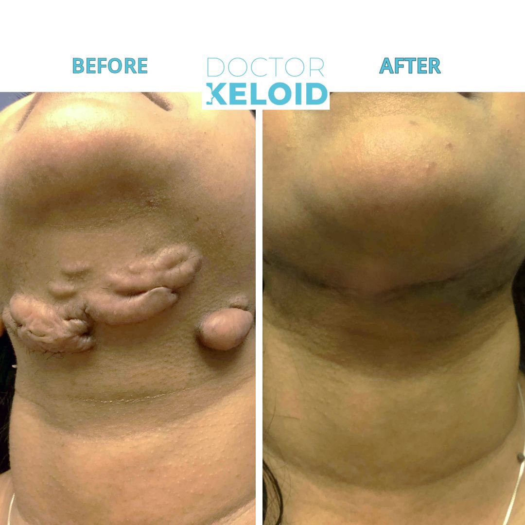 DrKeloid's tweet photo. It’s time to make a change! ✨Take action against your keloids and visit the Nations #1 Keloid Expert #DRKELOID ✨ Benefit from satisfying results with a technique that has over a 95% success rate. Your time to live keloid free is now⚡️ https://t.co/LY9ASWy6ox