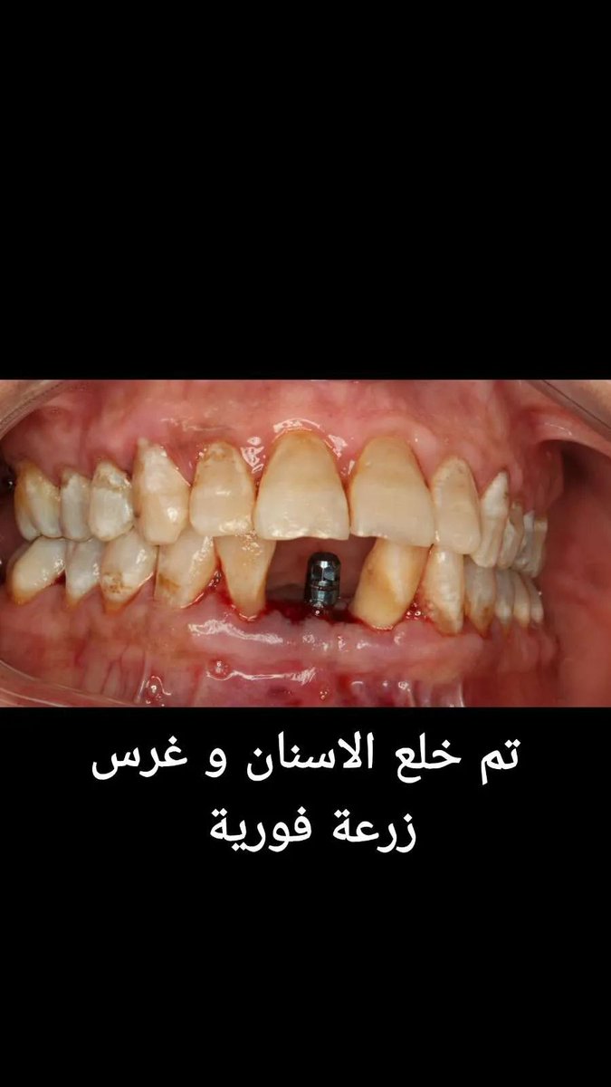 ASH_DDS's tweet photo. #زراعة_اسنان https://t.co/W0pFnrQiXw