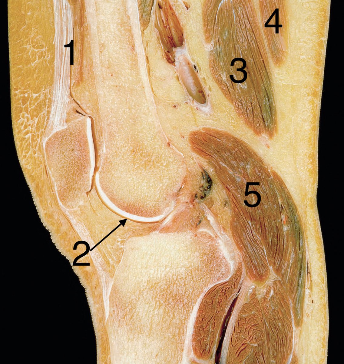 PasionAnatomia's tweet image. Corte #sagital de la articulación de la #rodilla (visión lateral). Parte 2
📌1 M. #CuádricepsFemoral
📌2 Cartílago articular del fémur
📌3 M. #semimembranoso
📌4 M. #semitendinoso
📌5 M. #gastrocnemio

📚 Atlas de anatomía humana. 9ª Ed. Rohen, Johannes W., © 2021. Elsevier