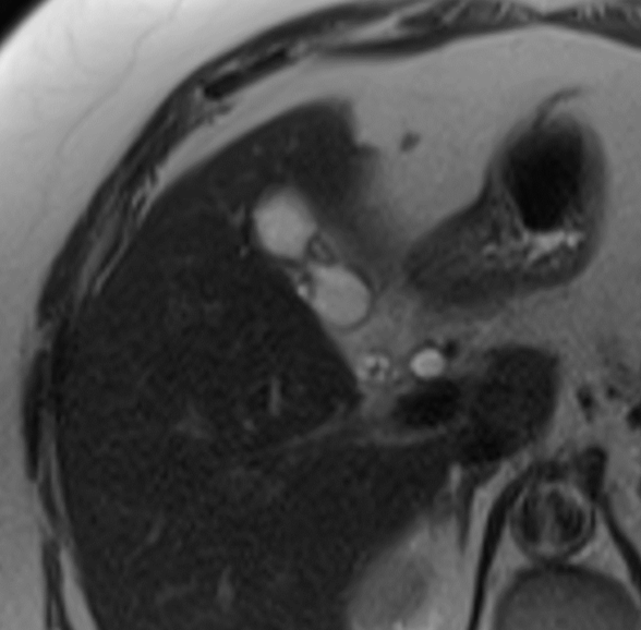 SAR DFP Benign Biliary Pathology (@sarbiliarydfp) on Twitter photo Challenge yourself with another biliary case: Case courtesy of Daniel R. Phadke
from UVA Radiology
<a href="/UVARadiology/">UVA Radiology</a>
70 yo woman who presents for follow-up of incidentally detected cystic renal mass. No RUQ symptoms. Challenge yourself with another biliary case: Case courtesy of Daniel R. Phadke
from UVA Radiology
<a href="/UVARadiology/">UVA Radiology</a>
70 yo woman who presents for follow-up of incidentally detected cystic renal mass. No RUQ symptoms.