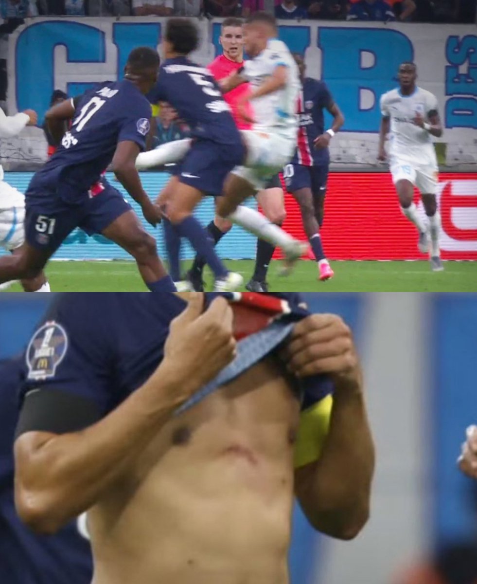 Ils se cachent derrière un pseudo rouge pas mérité alors qu'ils étaient TOTALEMENT à la rue avant le rouge et déjà mené au score.

Bref. Voici les séquelles du coup de pied d'Amine Harit sur Marquinhos... #OMPSG