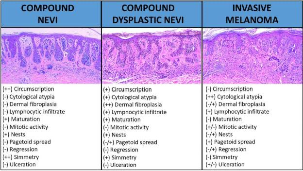 thejourneymate's tweet photo. Spectrum of Melanocytic Lesions 🔬

https://t.co/SokwxpvUAl https://t.co/tnA6P3IFM3