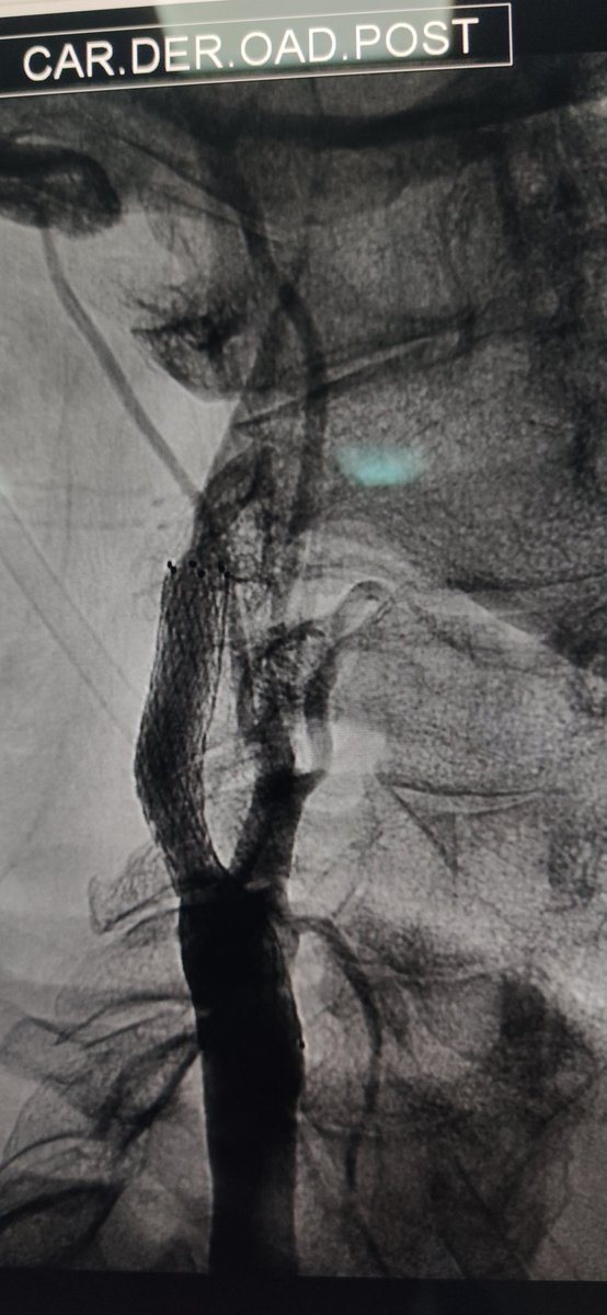 Carotid angioplasty with stent.
Who should do it? 🧐