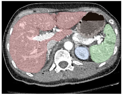 Radiology: Artificial Intelligence (@radiology_ai) on Twitter photo The <a href="/RSNA/">RSNA</a> Abdominal Traumatic Injury CT (RATIC) Dataset doi.org/10.1148/ryai.2… <a href="/BFlanksteak/">Adam Flanders, MD</a> <a href="/KMagudia/">Kirti Magudia, MD PhD</a> <a href="/AnaVillanuevaCa/">Ana Villanueva</a> #injury #radiology #AI The <a href="/RSNA/">RSNA</a> Abdominal Traumatic Injury CT (RATIC) Dataset doi.org/10.1148/ryai.2… <a href="/BFlanksteak/">Adam Flanders, MD</a> <a href="/KMagudia/">Kirti Magudia, MD PhD</a> <a href="/AnaVillanuevaCa/">Ana Villanueva</a> #injury #radiology #AI