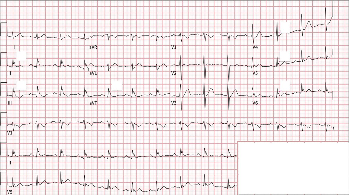 IM_Crit_'s tweet image. ICU/ED ECG Secrets:

New fear unlocked:

40 yo male, previously healthy, referred to the ED post-CPR after documented ventricular fibrillation
(VF). Vitals &amp;amp; physical exam: OK. No family history of sudden death. No drugs.

Any concern from this 12-lead electrocardiogram (ECG)?