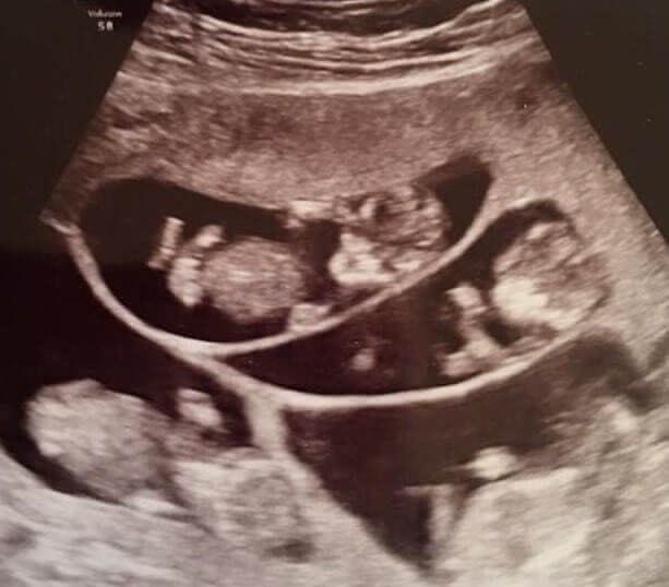 ᅟᅟᅟᅟᅟᅟᅟᅟᅟᅟᅟᅟᅟᅟᅟᅟᅟᅟᅟ
                               𝑁𝐸𝑆𝑇𝐻𝐴
                 ────  ❤️‍🔥  ────
                             @𝘴𝘭𝘪𝘷𝘦𝘳𝘧𝘪𝘳𝘦 :
                    My five baby’s
                      are growing ❤️