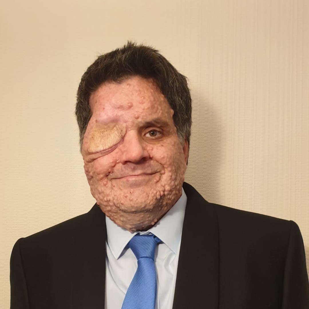 FaceEquality's tweet photo. "If we don't speak out, we can't drive change."

After being asked to leave a cafe after complaints he was "scaring customers," Oliver has been making it his mission to raise awareness of appearance-related discrimination: https://t.co/3jjp2CzQhM https://t.co/a2mm2nVpdX