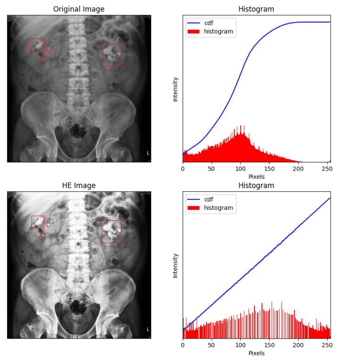 Bioeng_MDPI's tweet image. 🌟 Excited to share the Editor’s Choice Paper, Volume 9 Issue 12: Deep Learning Model for Computer-Aided Diagnosis of Urolithiasis Detection from Kidney–Ureter–Bladder Images👉 mdpi.com/2306-5354/9/12…

#computer_aided #diagnosis #kidney #ureter #bladder #deep_learning