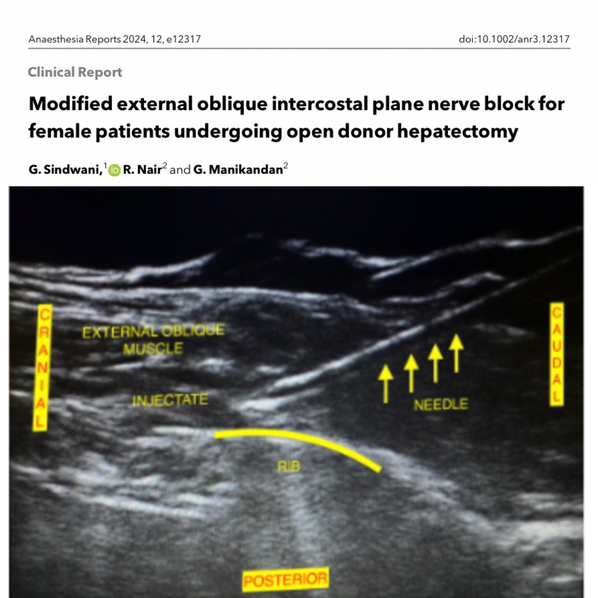 Anaes_Reports's tweet image. For #blocktober24 we’ve made this case report #freeforaweek
Modified external oblique intercostal plane blocks were effective for managing post-op pain for an open donor hepatectomy. @SindwaniGaurav @jeffgadsden #anaesthesia #anasthesia 

…-publications.onlinelibrary.wiley.com/doi/epdf/10.10…