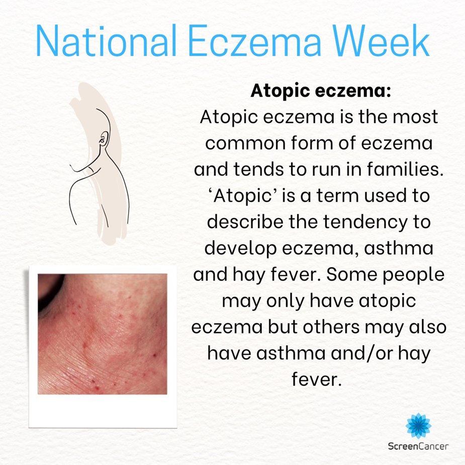 ScreenCancer_UK's tweet image. Yesterday we made a post about #Eczema, today we want to tell you a little bit about the most common type of Eczema. #Skin #Skincondition