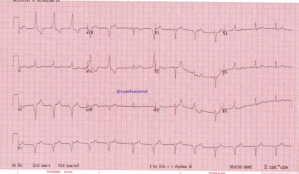 syamkumarmd's tweet photo. Best explanation for the change in QRS morphology? #EPeeps #Fellowsfirst https://t.co/THmTm2gHIm