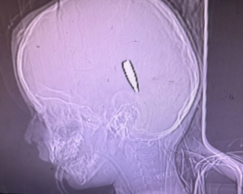 angertab's tweet photo. As a prior Law Enforcement Officer, Ret. Green Beret and Sniper, I am willing to stake my ENTIRE CAREER and REPUTATION that the images provided by the NYT do not depict direct fire engagements from the IDF.

| Deep Dive Into Gaza Medical Staff Reputation |

The claims made by the doctors and nursing staff do not change ballistics and basic math. The ballistic information I published about the M855 (5.56 Nato) still stands (source 1).

Al Shifa Hospital
In November of 2023, the Al Shifa hospital was the center of controversy as the IDF moved in. The IDF claimed the hospital was being used by Hamas, a claim hospital staff denied:

According to a CNN article dated Nov. 11, 2023:
"Israel has accused Hamas of using hospitals as cover — a charge doctors at Shifa and the militant group deny" (Source 2).

Despite the doctors claims, the IDF found video footage of armed Hamas terrorists on the grounds of the Al Shifa hospital escorting hostages. Additionally, tunnels were uncovered on the grounds of the Al Shifa Hospital. So were the bodies of hostages. (Sources 3 and 4). 

Al Nassar Hospital:

'This is a crime against humanity': Gaza doctor on mass grave uncovered at hospital in Khan Younis (source 5)

Following the IDF's withdrawal from the Nasser Hospital in April of 2024, reports of mass graves and executions on the grounds of the Al Shifa and Nasser Medical complexes began to surface with over "300 bodies" reportedly discovered (Source 6). 

This time, instead of doctors confirming the reports surfacing online, they remained silent even as the UN demanded investigations (Source 7) . 

I could find no record of doctors directly claiming the IDF executed people on the grounds of either hospital. I also could find no record of the doctors denying the claims. Gaza officials however said otherwise claiming Israel executed civilians (Source 6). 

"The head of Nasser Hospital in Gaza’s Khan Younis said 150 bodies were buried in the yard of the hospital after they started to decompose in the mortuary" (Source 8)

In Jan of 2024, long before the IDF entered Khan Younis, hospital staff stated they dug mass graves on the grounds of Al Nasser Hospital (Source 8). Despite all of this, I could find no records of doctors providing the exculpatory evidence or denying any of the reports from the Gazan Officials that Israel had murdered civilians on the grounds of either hospital. 

Do your own research. The doctors lied. Gaza Health Officials lied. The media lies. 

SOURCES:
Al Shifa
1 - Ballistic data on the M855
Original Ballistics Information disproving the NYT claim:
https://t.co/ZkldPlEQ1P

2 - Al Shifa Doctors deny Hamas at the hospital
https://t.co/rrIXLBPlTs

3 - Hostage Bodies at Al Shifa
https://t.co/qHN0f6CbsC

4 - Video of Tunnels under Al Shifa; Surveillance Video of Hamas and Hostages at Al Shifa 
https://t.co/FIev7a9FLE

Nasser
5 - Video showing mass graves being exhumed
https://t.co/VswZHCB8s7

6 - Mass Graves and Executions
https://t.co/kTVXG2i6a2
 
 7 - UN Demands Investigations
https://t.co/7wA8m2xWOD

8 - Mass Graves Started In Jan 2024
https://t.co/8NEH1Biwgw