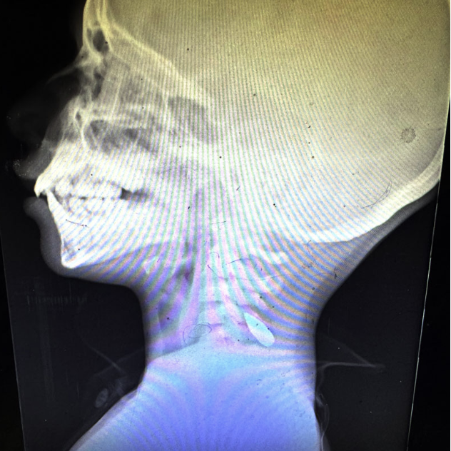 angertab's tweet photo. As a prior Law Enforcement Officer, Ret. Green Beret and Sniper, I am willing to stake my ENTIRE CAREER and REPUTATION that the images provided by the NYT do not depict direct fire engagements from the IDF.

| Deep Dive Into Gaza Medical Staff Reputation |

The claims made by the doctors and nursing staff do not change ballistics and basic math. The ballistic information I published about the M855 (5.56 Nato) still stands (source 1).

Al Shifa Hospital
In November of 2023, the Al Shifa hospital was the center of controversy as the IDF moved in. The IDF claimed the hospital was being used by Hamas, a claim hospital staff denied:

According to a CNN article dated Nov. 11, 2023:
"Israel has accused Hamas of using hospitals as cover — a charge doctors at Shifa and the militant group deny" (Source 2).

Despite the doctors claims, the IDF found video footage of armed Hamas terrorists on the grounds of the Al Shifa hospital escorting hostages. Additionally, tunnels were uncovered on the grounds of the Al Shifa Hospital. So were the bodies of hostages. (Sources 3 and 4). 

Al Nassar Hospital:

'This is a crime against humanity': Gaza doctor on mass grave uncovered at hospital in Khan Younis (source 5)

Following the IDF's withdrawal from the Nasser Hospital in April of 2024, reports of mass graves and executions on the grounds of the Al Shifa and Nasser Medical complexes began to surface with over "300 bodies" reportedly discovered (Source 6). 

This time, instead of doctors confirming the reports surfacing online, they remained silent even as the UN demanded investigations (Source 7) . 

I could find no record of doctors directly claiming the IDF executed people on the grounds of either hospital. I also could find no record of the doctors denying the claims. Gaza officials however said otherwise claiming Israel executed civilians (Source 6). 

"The head of Nasser Hospital in Gaza’s Khan Younis said 150 bodies were buried in the yard of the hospital after they started to decompose in the mortuary" (Source 8)

In Jan of 2024, long before the IDF entered Khan Younis, hospital staff stated they dug mass graves on the grounds of Al Nasser Hospital (Source 8). Despite all of this, I could find no records of doctors providing the exculpatory evidence or denying any of the reports from the Gazan Officials that Israel had murdered civilians on the grounds of either hospital. 

Do your own research. The doctors lied. Gaza Health Officials lied. The media lies. 

SOURCES:
Al Shifa
1 - Ballistic data on the M855
Original Ballistics Information disproving the NYT claim:
https://t.co/ZkldPlEQ1P

2 - Al Shifa Doctors deny Hamas at the hospital
https://t.co/rrIXLBPlTs

3 - Hostage Bodies at Al Shifa
https://t.co/qHN0f6CbsC

4 - Video of Tunnels under Al Shifa; Surveillance Video of Hamas and Hostages at Al Shifa 
https://t.co/FIev7a9FLE

Nasser
5 - Video showing mass graves being exhumed
https://t.co/VswZHCB8s7

6 - Mass Graves and Executions
https://t.co/kTVXG2i6a2
 
 7 - UN Demands Investigations
https://t.co/7wA8m2xWOD

8 - Mass Graves Started In Jan 2024
https://t.co/8NEH1Biwgw