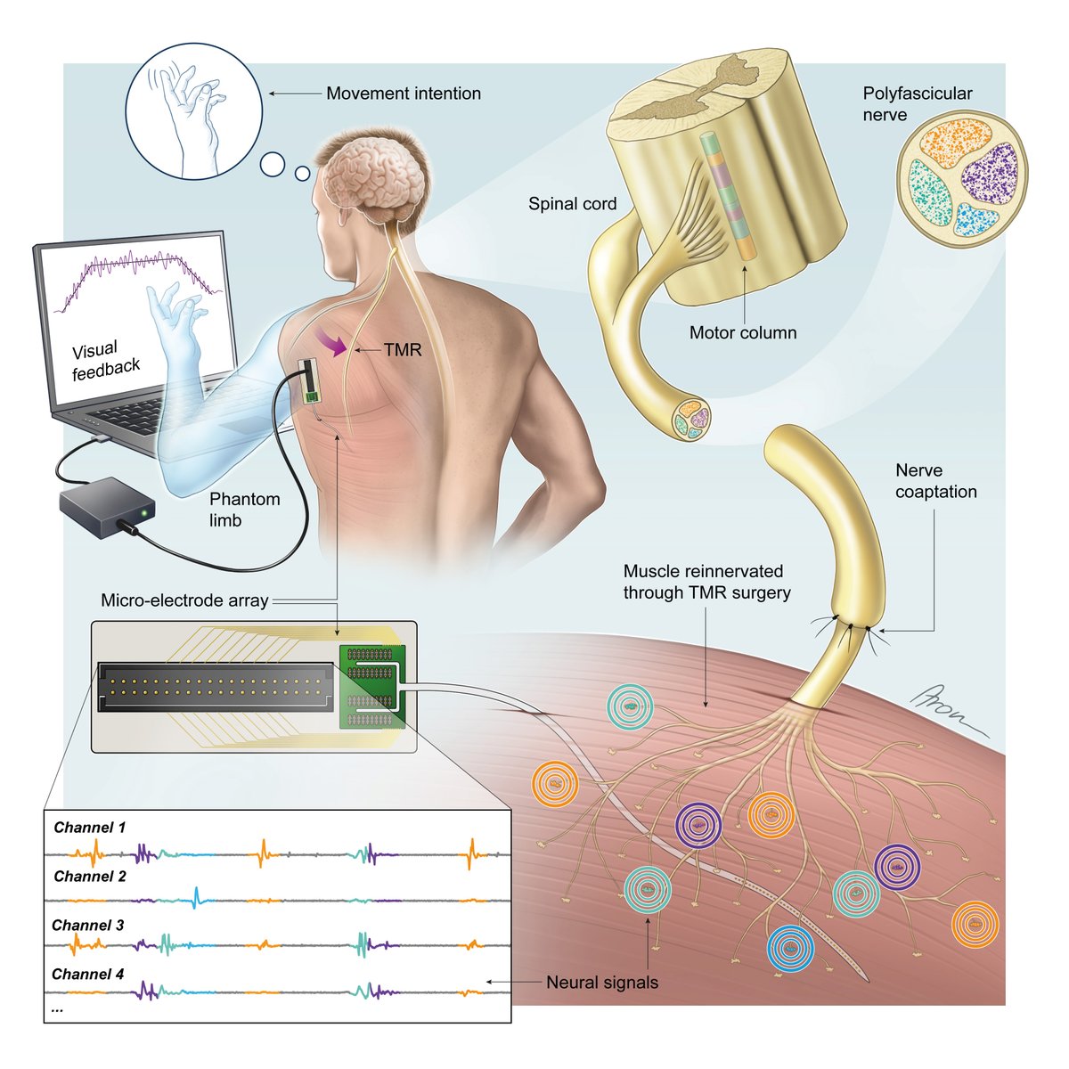 Laura (@_ferrantelaura) on Twitter photo Excited to share our work: "Separation of Neural Drives to Muscles from Transferred Polyfunctional Nerves using Implanted Micro-electrode Arrays".
Preprint: lnkd.in/d8BKnhuZ
Thank you to all co-authors! <a href="/NeuroCon_ICL/">NeuroCon</a> <a href="/imperialcollege/">Imperial College London</a> <a href="/MedUni_Wien/">MedUni Wien</a> Excited to share our work: "Separation of Neural Drives to Muscles from Transferred Polyfunctional Nerves using Implanted Micro-electrode Arrays".
Preprint: lnkd.in/d8BKnhuZ
Thank you to all co-authors! <a href="/NeuroCon_ICL/">NeuroCon</a> <a href="/imperialcollege/">Imperial College London</a> <a href="/MedUni_Wien/">MedUni Wien</a>