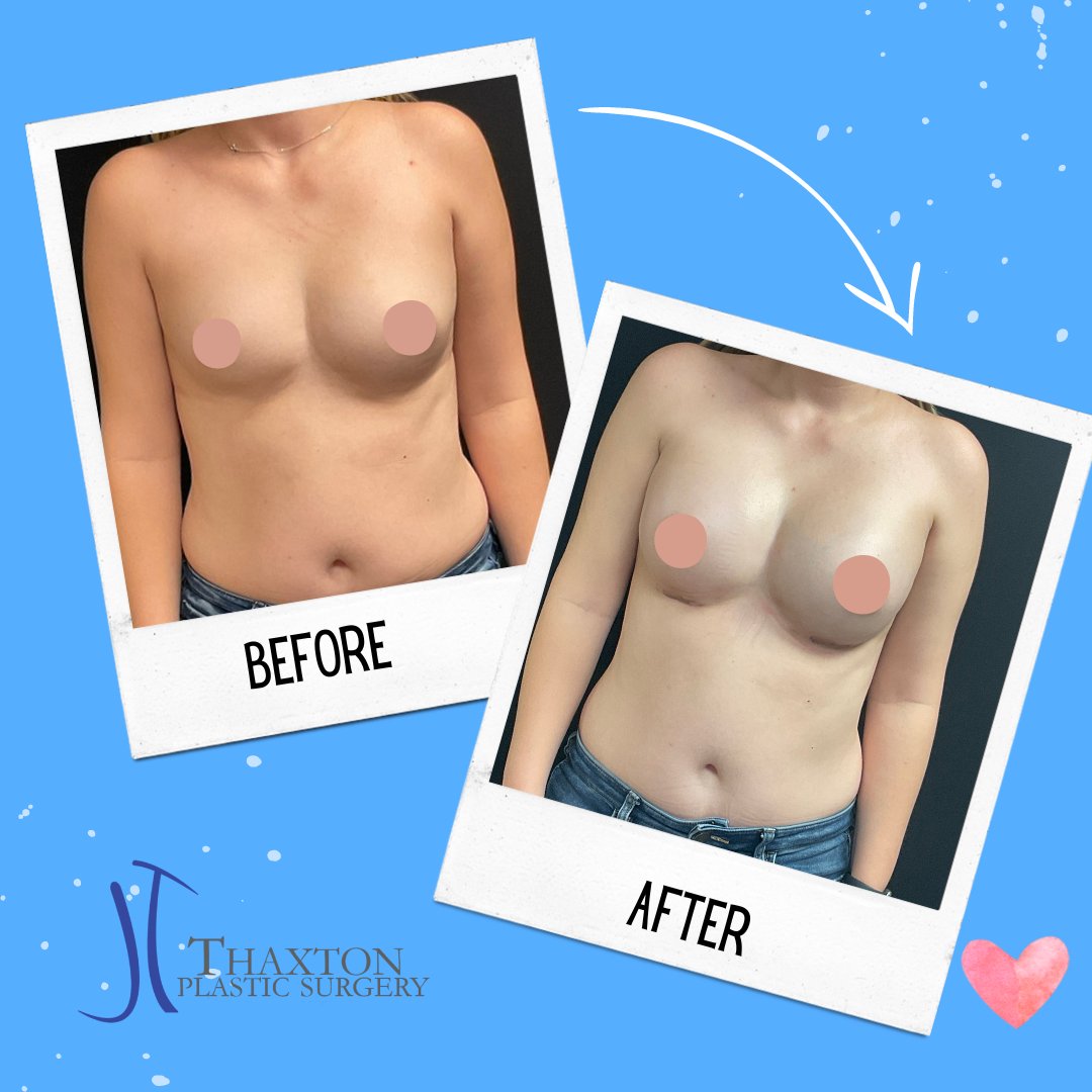 ThaxtonPlastic's tweet photo. #BreastAugmentation  before &amp; after. Breast aug surgeries are done in our own accredited OR. #breastimplants #charlestonwv #parkersburghwv #beckleywv Call or text for more information (304)925-8949 https://t.co/3Bl5O1517H