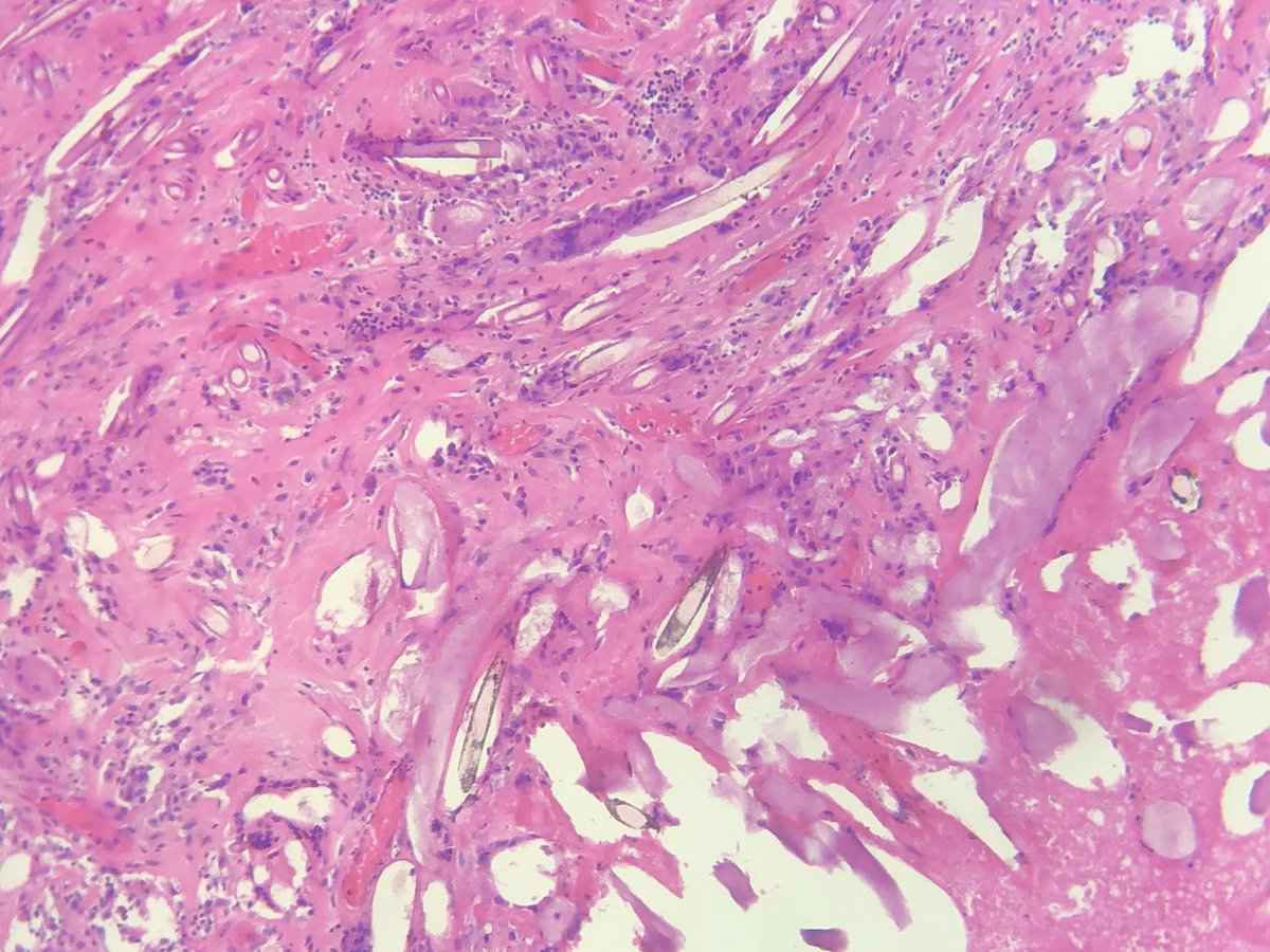 asifwahab2012's tweet image. Hi Twitter family! Need help
Incidental nodule found on wall of bladder during lower segment Caesarean section. ? Foreign body 
This lady has h/o LSCS 3 years back. 
Need help to identify type of foreign body material. #Twitterpathology #PathX #Pathology 
More images to follow 👇