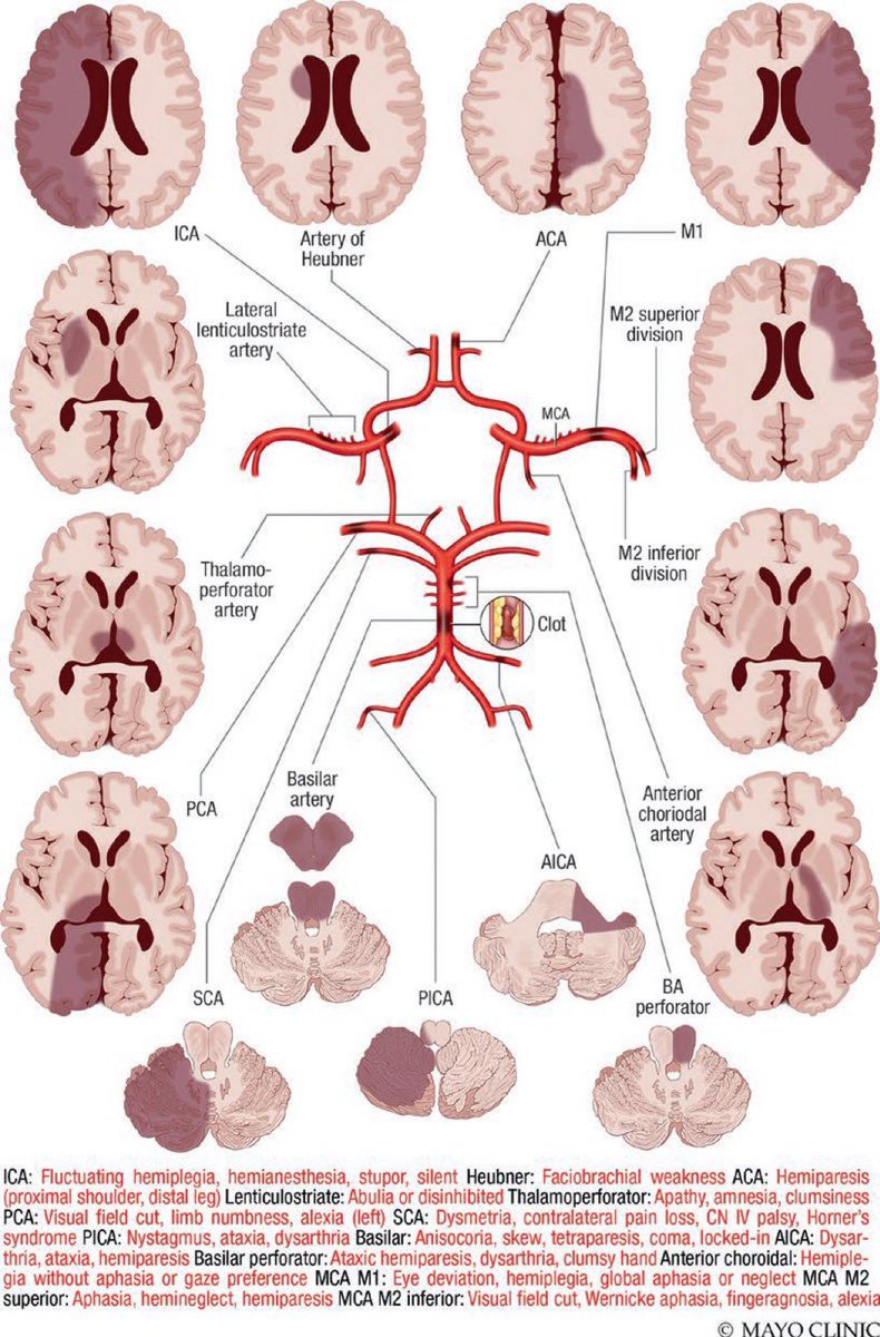 BrownJHM's tweet photo. Stroke - Vascular territories and deficits (Mayo Clinic) #MedX https://t.co/UgrLPMNNoP