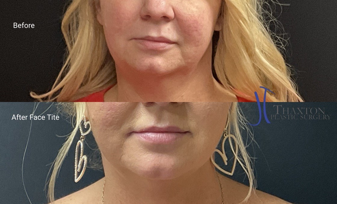 Rebeccamtmd's tweet photo. Face tite before &amp; after. A minimally invasive procedure to tighten your face and help restore your jawline. #facetite #nonsurgicalface #charlestonwv #beckleywv #parkersburghwv https://t.co/F3ykuUgtaM