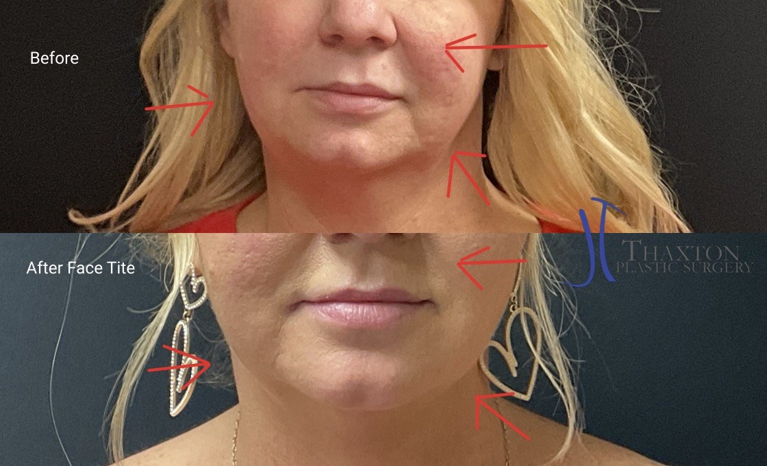 Rebeccamtmd's tweet photo. Face tite before &amp; after. A minimally invasive procedure to tighten your face and help restore your jawline. #facetite #nonsurgicalface #charlestonwv #beckleywv #parkersburghwv https://t.co/F3ykuUgtaM