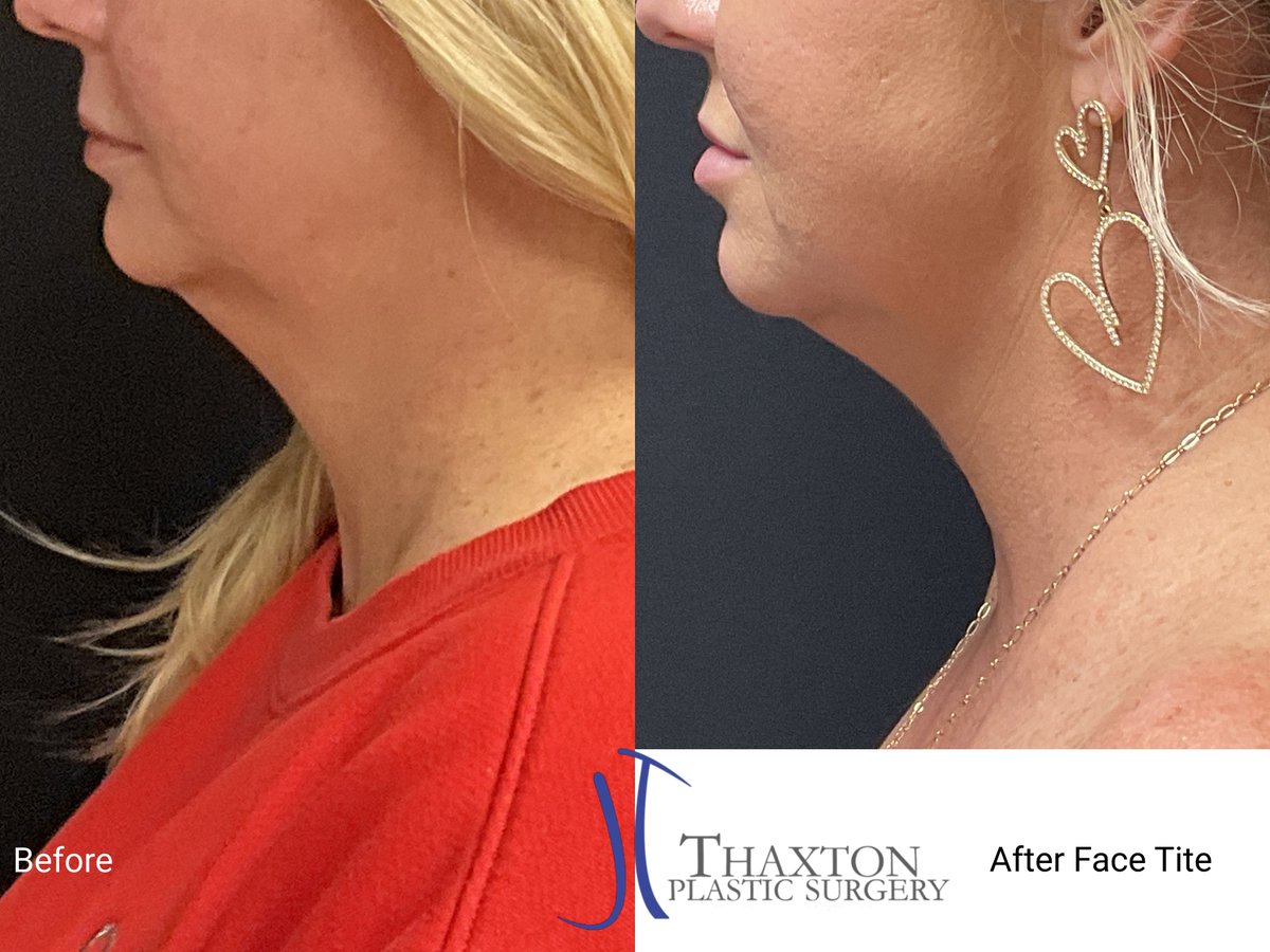 Rebeccamtmd's tweet photo. Face tite before &amp; after. A minimally invasive procedure to tighten your face and help restore your jawline. #facetite #nonsurgicalface #charlestonwv #beckleywv #parkersburghwv https://t.co/F3ykuUgtaM