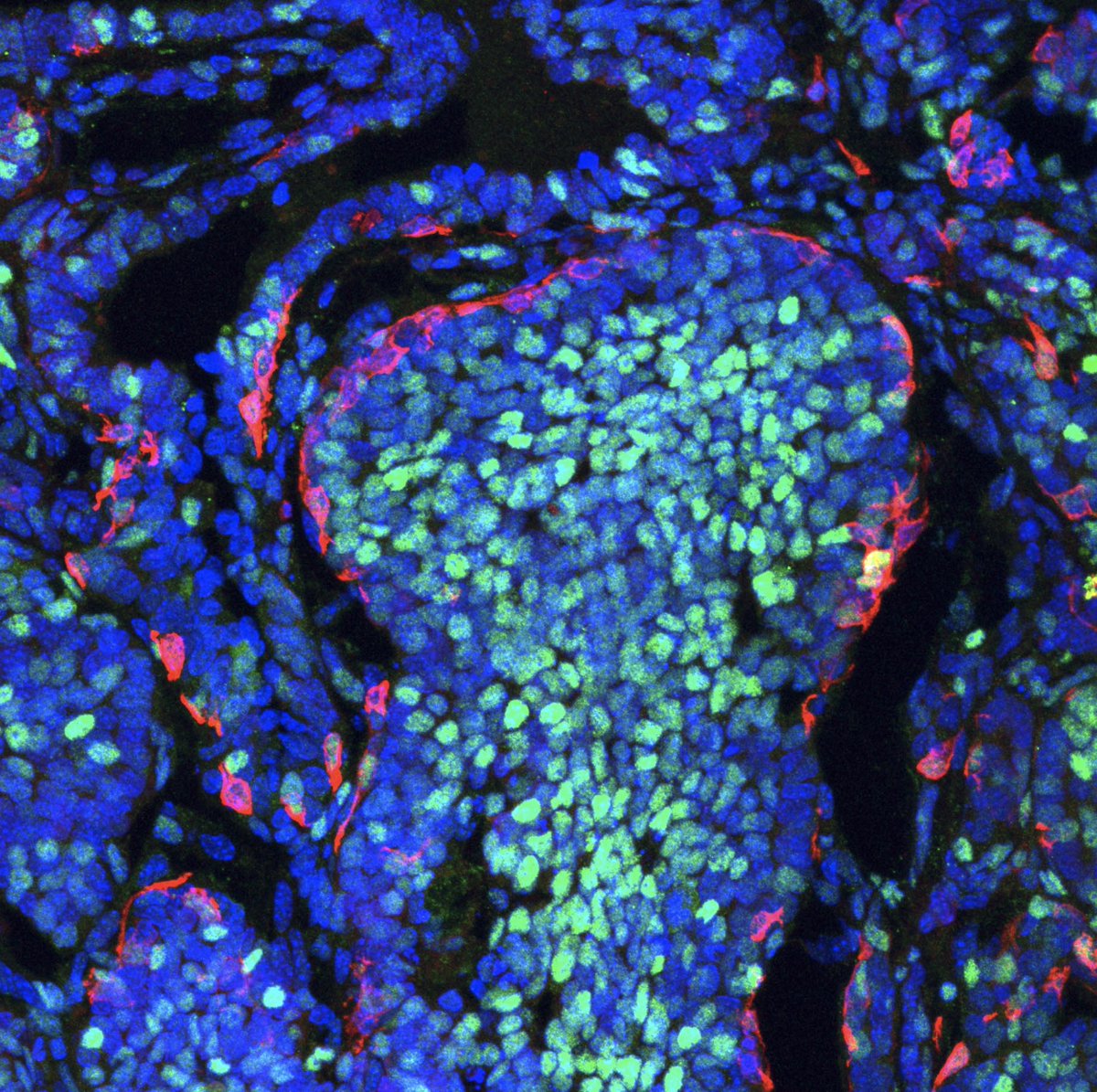 CSIC (@csic) on Twitter photo 🦠 El equipo de <a href="/NietoAngela/">Angela Nieto</a> en el <a href="/NeuroAlc/">Instituto de Neurociencias UMH-CSIC</a> demuestra que dentro de cada tumor hay grupos de células que reciben instrucciones para expandirse de forma maligna y otros que se encargan de combatir el daño del tumor canceroso.
➡️ bit.ly/4h3spAV 🦠 El equipo de <a href="/NietoAngela/">Angela Nieto</a> en el <a href="/NeuroAlc/">Instituto de Neurociencias UMH-CSIC</a> demuestra que dentro de cada tumor hay grupos de células que reciben instrucciones para expandirse de forma maligna y otros que se encargan de combatir el daño del tumor canceroso.
➡️ bit.ly/4h3spAV