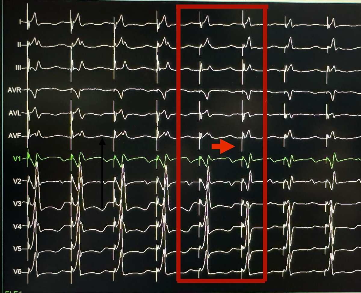 The challenge in LBBP is the
 QRS transition during voltage reduction. #SelectiveLeftBundlePacing ⁦<a href="/ArbaizaSimon/">Jorge Luis Arbaiza Simon</a>⁩ ⁦<a href="/AbbottNews/">Abbott</a>⁩ ⁦⁦<a href="/MdHuang/">Weijian Huang</a>⁩ ⁦<a href="/leftbundle/">Mintu Turakhia, MD MS</a>⁩ ⁦<a href="/MargaridaPujol/">Margarida Pujol Lopez</a>⁩ ⁦⁦<a href="/ugurcanpolatmd/">Ugur Canpolat</a>⁩ ⁦<a href="/nlcabanillas/">Lopez Cabanillas Nestor</a>⁩ ⁦<a href="/LAHRSonline1/">LAHRS</a>⁩