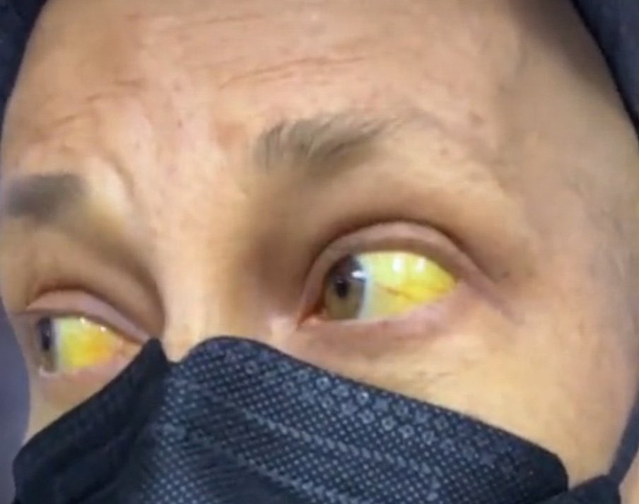 في حال مريض دخل عندك للعيادة ولون عيونه كذا 

ايش اول مرض تفكر فيه ؟