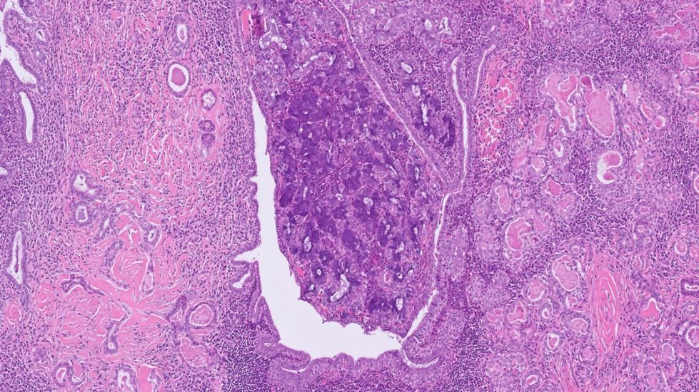 Image of the Week!

Submitted by: Hsin-Yi Chang, M.D.
Directory Profile: buff.ly/3YoWN1u
Subspecialty: Head &amp; neck
Diagnosis: Mucoacinar carcinoma

#PathTwitter #PathologyOutlines #ENTPath