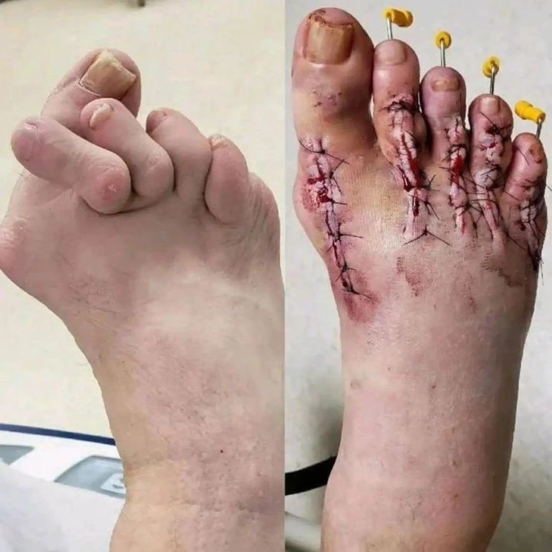 Doctors__squad's tweet photo. A 56 year old patient with severe toe misalignment due to rheumatoid arthritis, before and after surgery https://t.co/arIN0fryNo